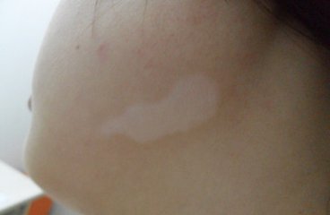 白癜风图片 白癜风症状图片