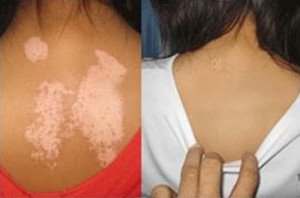 白癜风图片 白癜风治疗图片