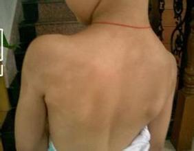 白癜风患处出现红肿的原因是什么 白癜风患处出现红肿的原因是什么.jpg