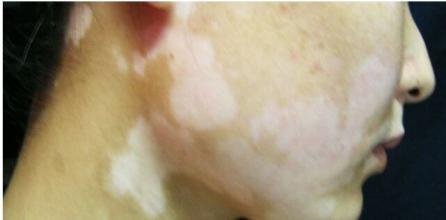 孩子脸上的白癜风总是治不好咋回事? 孩子脸上的白癜风总是治不好咋回事?.jpg