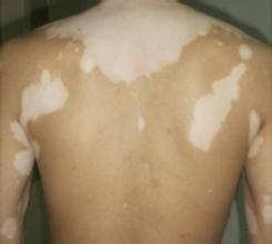 家族遗传性的白癜风一般有哪些特征呢 家族遗传性的白癜风一般有哪些特征呢.jpg