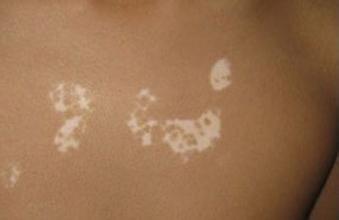 白癜风治了2年没效果,还能治好吗 白癜风治了2年没效果,还能治好吗.jpg