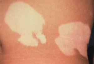 判断白斑是不是早期白癜风的诀窍是什么 判断白斑是不是早期白癜风的诀窍是什么.jpg