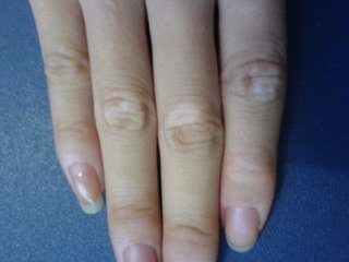 白癜风症状图片